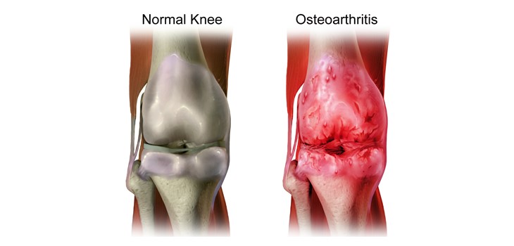One_step_closer_to_therapies_based_on_cartilage_regeneration