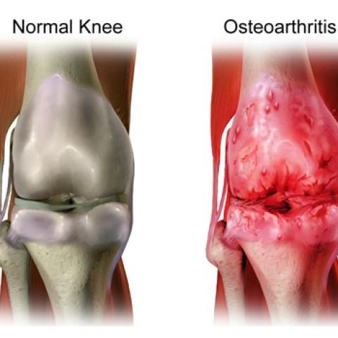 One_step_closer_to_therapies_based_on_cartilage_regeneration